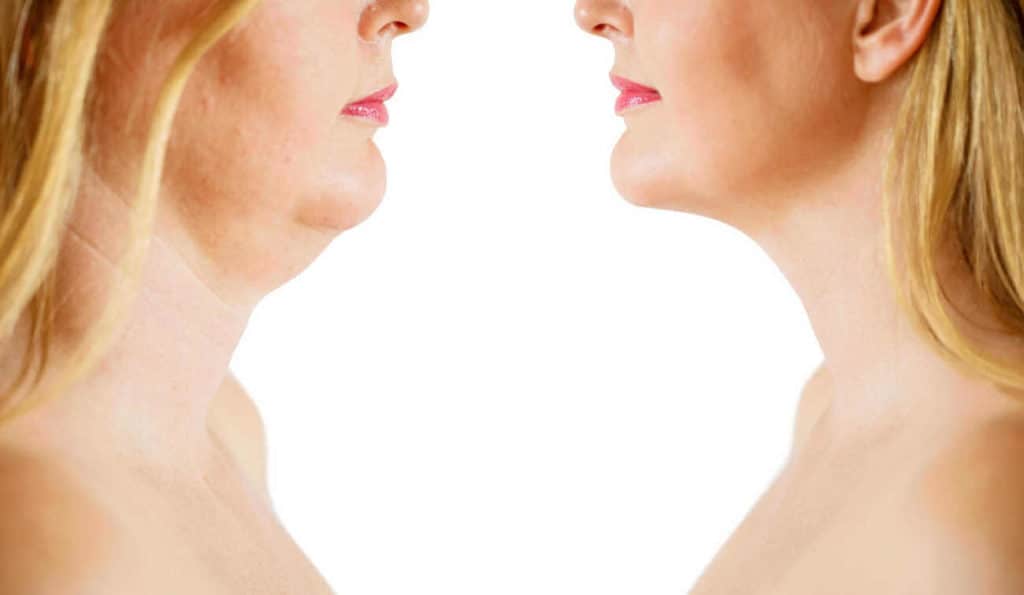 Double Chin treatment Hendon before and after results