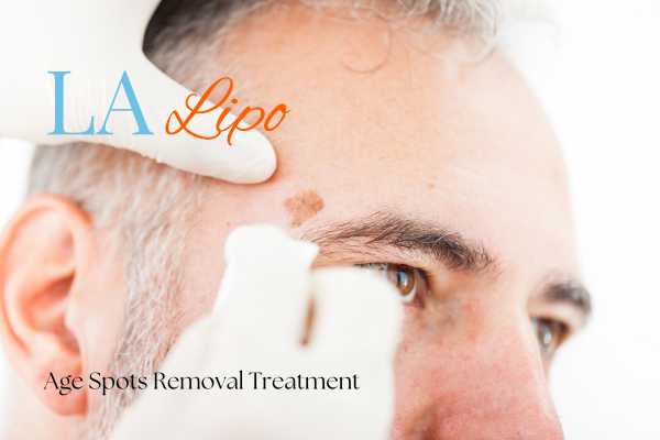What Are the Most Effective Treatments for Age Spots Hendon?