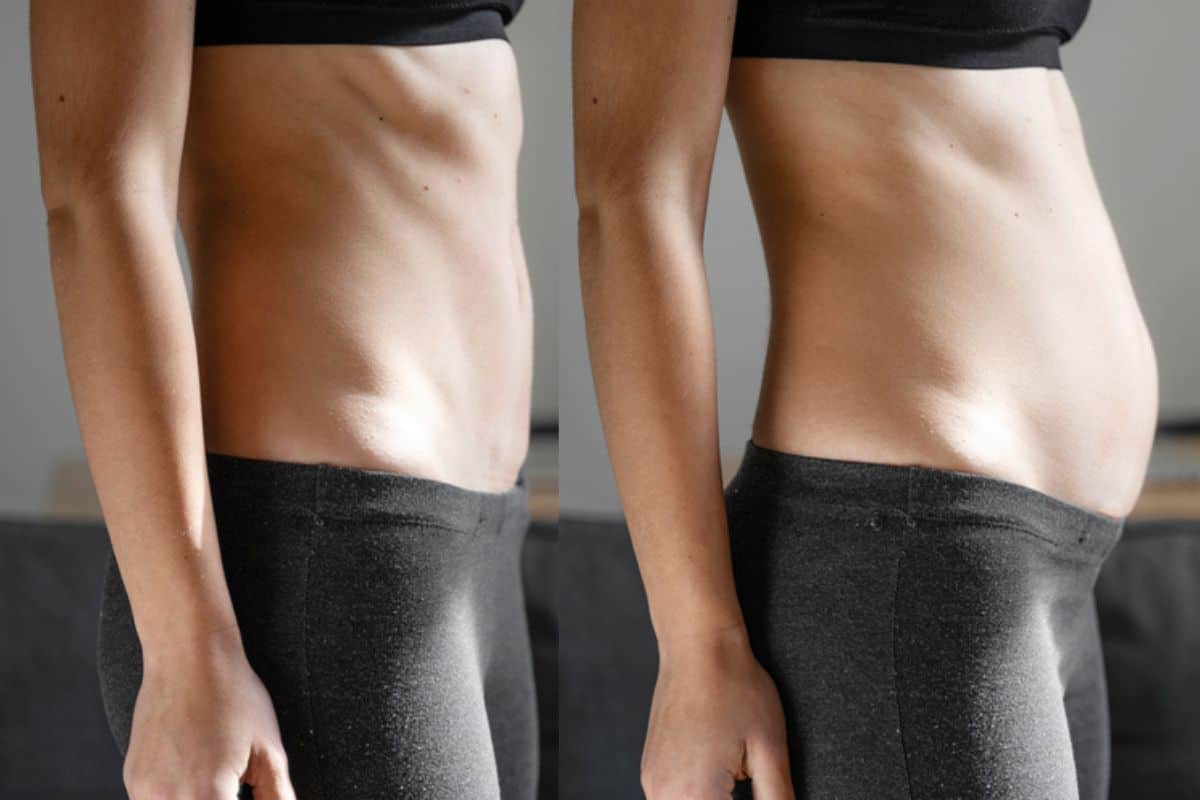 How long does diastasis recti take to improve Hendon?