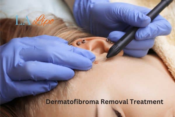 Dermatofibroma Removal Treatment Hendon