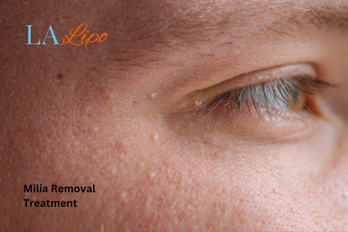 Cryopen Milia Removal: Is It the Easiest and Safest Option Hendon?
