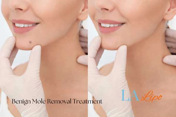 Before-and-after results following benign mole-removal treatment Hendon