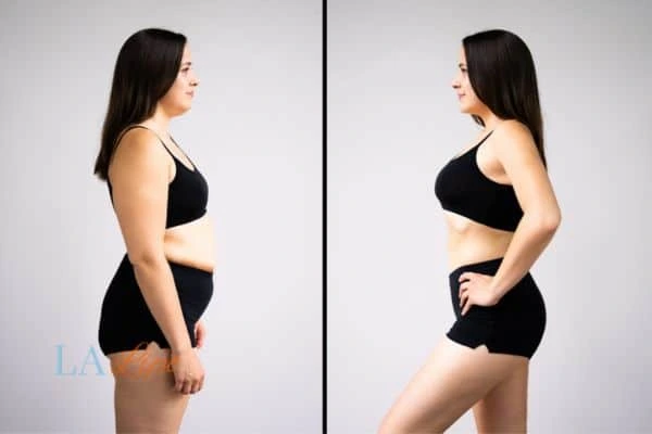 image of woman before and after results of LA-EMS Body Sculpting Hendon to help treat Diastasis recti