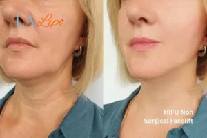 hi-fu for wrinkles Hendon before and after results