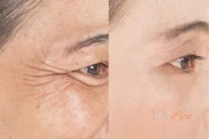 Before and after results of woman - HI-fu wrinkles reduction treatment Hendon