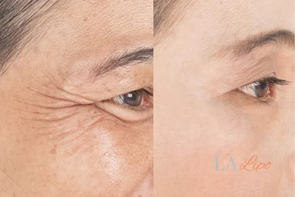 Before and after results of woman - HI-fu wrinkles reduction treatment Hendon