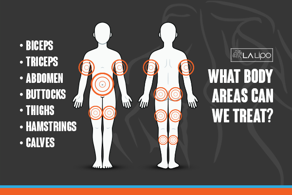 Graphic to show areas you can have LA-EMS Body Sculpting Hendon treatment.