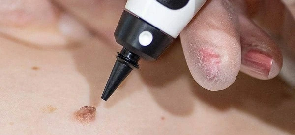 skin tag removal using cryopen Hendon