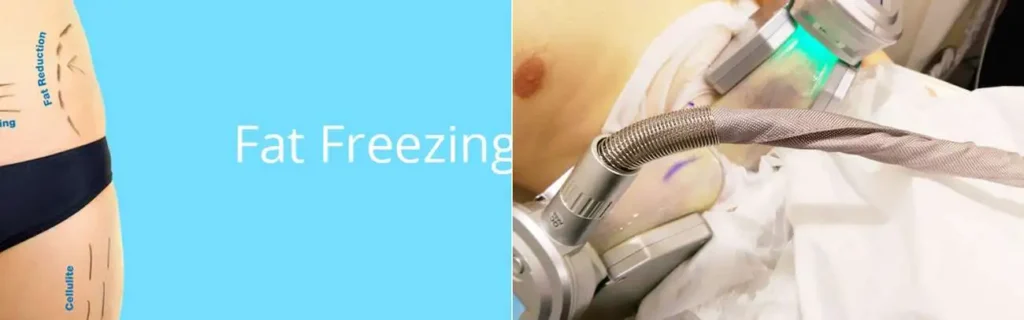 Fat freezing Hendon on multiple areas of the body