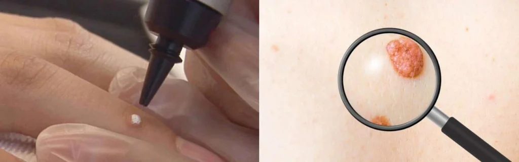 CryoPen practitioner Hendon assessing a benign mole before treatment