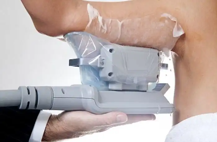 Picture of fat freezing Hendon on the upper arms.