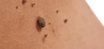 image of a skin tag Hendon