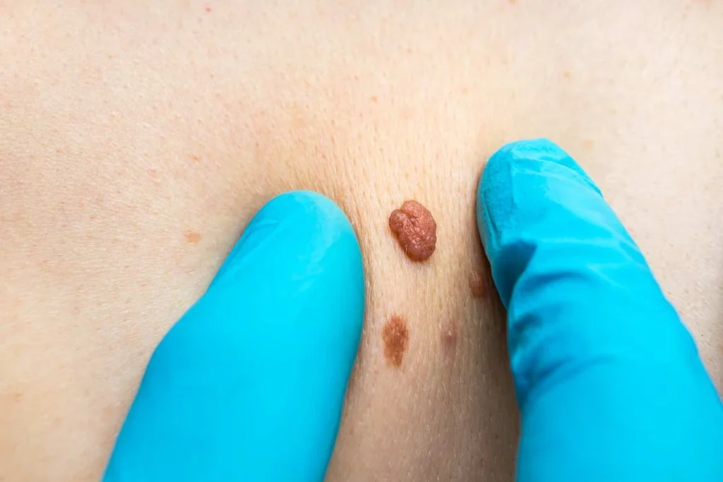 Consultant examining a skin tag Hendon