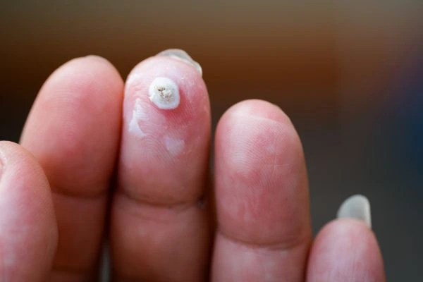 wart on person finger - cryotherapy to treat from LA LIPO Hendon