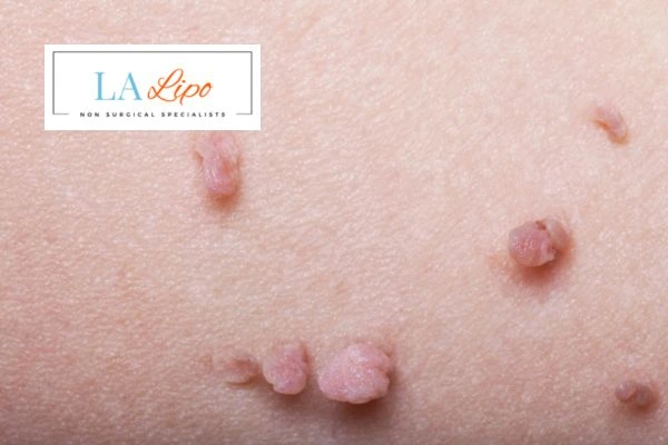 Does cryopen skin tag removal Hendon hurt? Find out now call our team today!