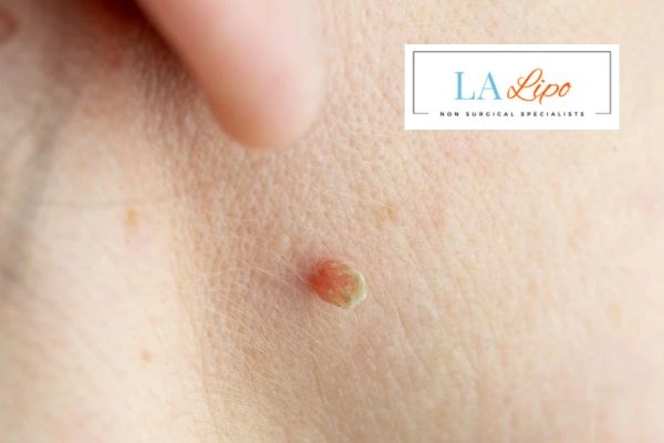 Book skin tag removal Hendon today speak to our team now!