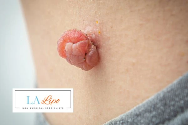 Interested in skin tag removal Hendon? Concerned about the pain? Find out more today!