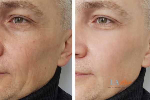 See the amazing results of Morpheus8 Treatment Hendon!