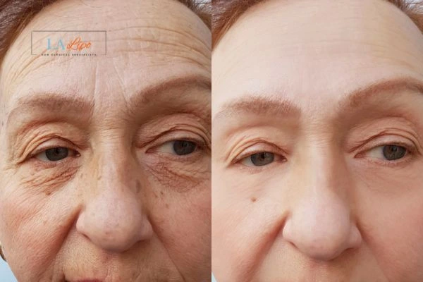 The powerful benefits of Morpheus8 Treatment Hendon - Call Our team today!