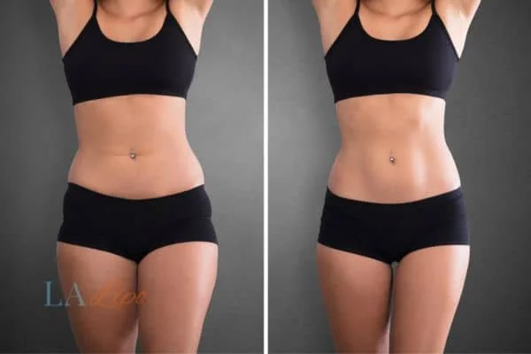 before and after results of non-surgical treatment to help a woman's body image and mental health Hendon