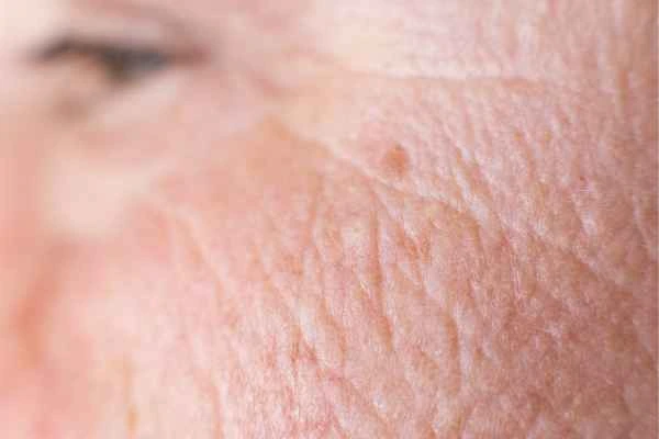 close up picture of a woman's face showing an age spot Hendon