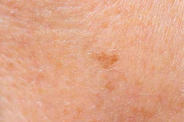 close up picture of age spots Hendon