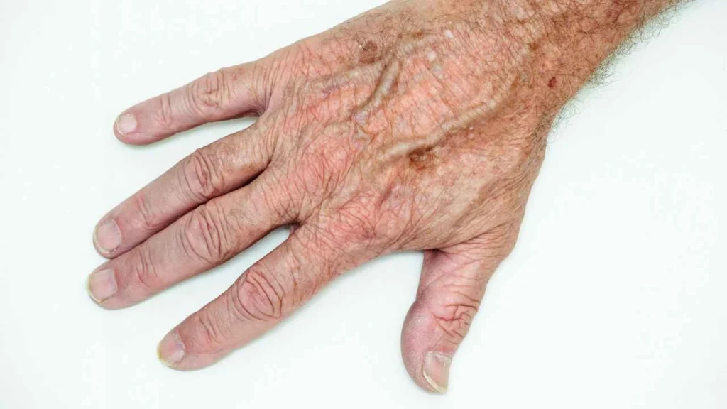 Male hand showing age spot Hendon