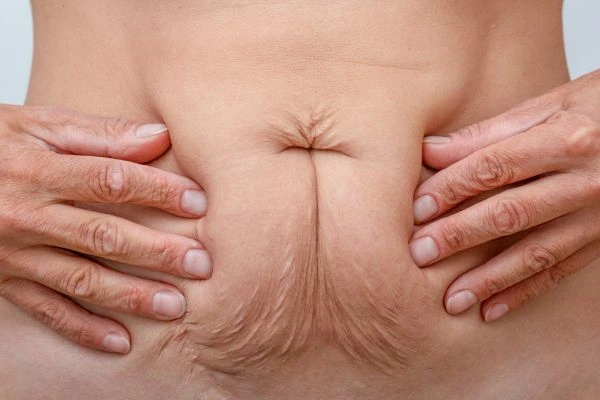 Image of a woman's stomach with loose skin - example of skin tightening Hendon options