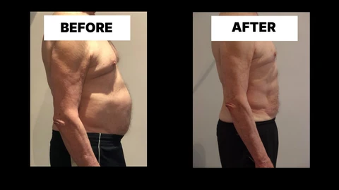 What Symptoms Can Diastasis Recti Cause in Men? Weak Core, Back Pain and Poor Posture Hendon